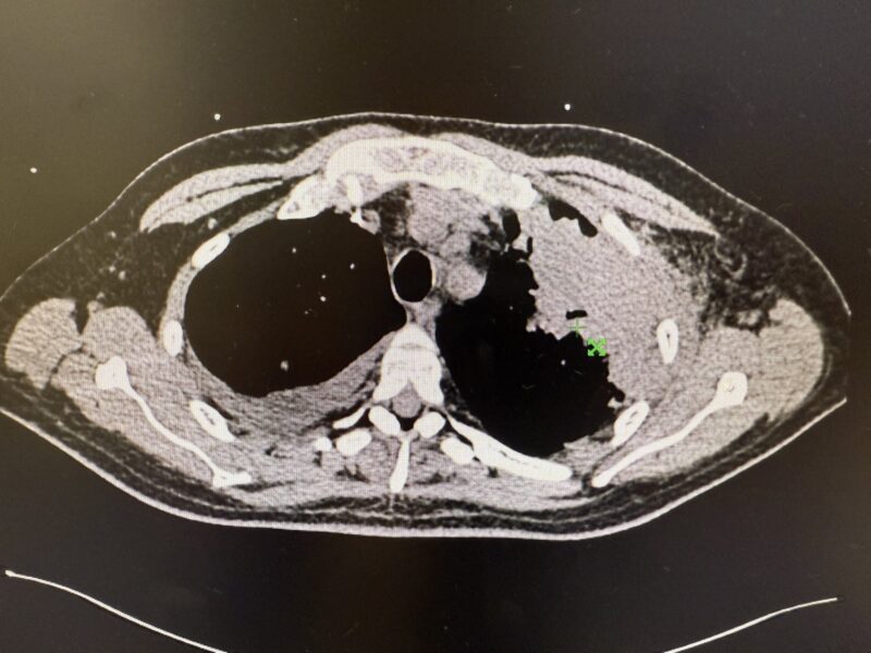 Talha Badar: 41 Yrs Old With AML Required Re-Induction Due to Residual Disease at D14 2 Talha Badar