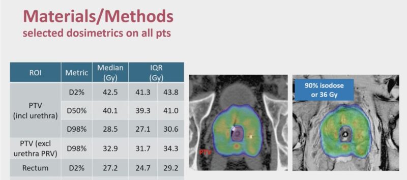 Stereotactic Radiotherapy