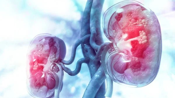 Sara Coca Membribes: Belzutifan Combos Show Promise in RCC