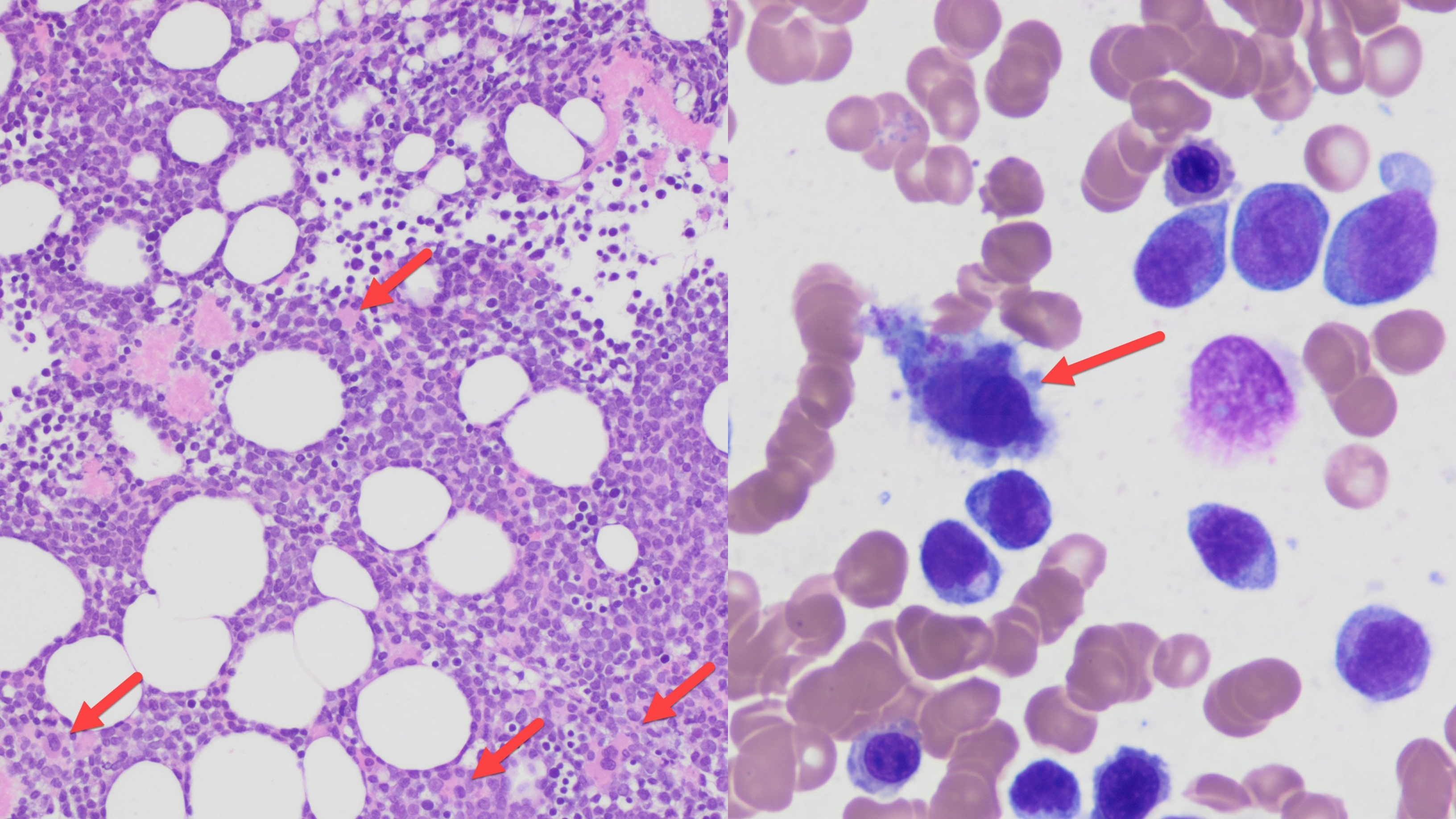Sanam Loghavi: Raising Awareness of Aggressive AML with Chromosome 3 Inversion