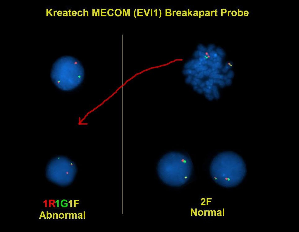 Sanam Loghavi: Raising Awareness of Aggressive AML with Chromosome 3 Inversion