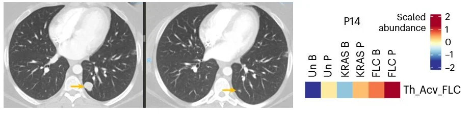 Mark Yarchoan: A Therapeutic Peptide Vaccine for Fibrolamellar Hepatocellular Carcinoma