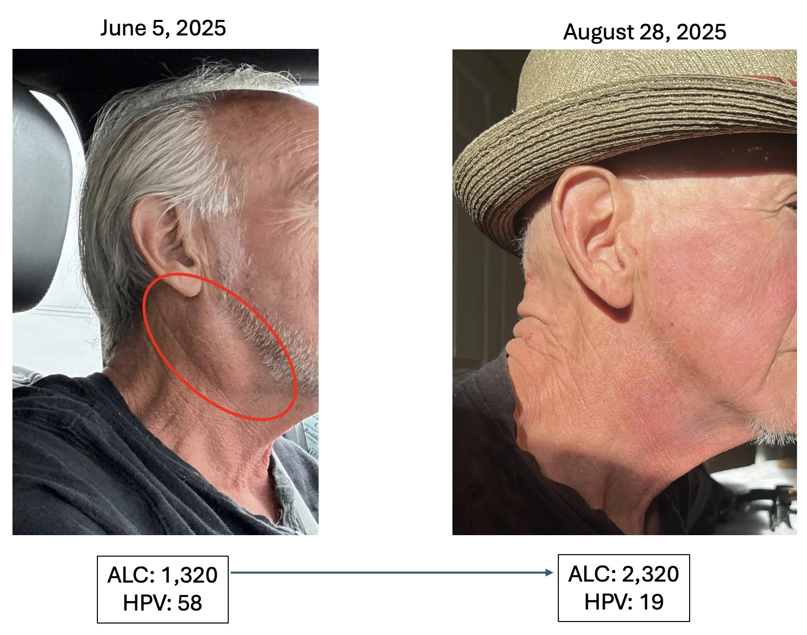 Patrick Soon-Shiong: The Overlooked Immune Failure Driving Cancer Mortality - A Clinical Blind Spot 6 Patrick Soon-Shiong: The Overlooked Immune Failure Driving Cancer Mortality - A Clinical Blind Spot