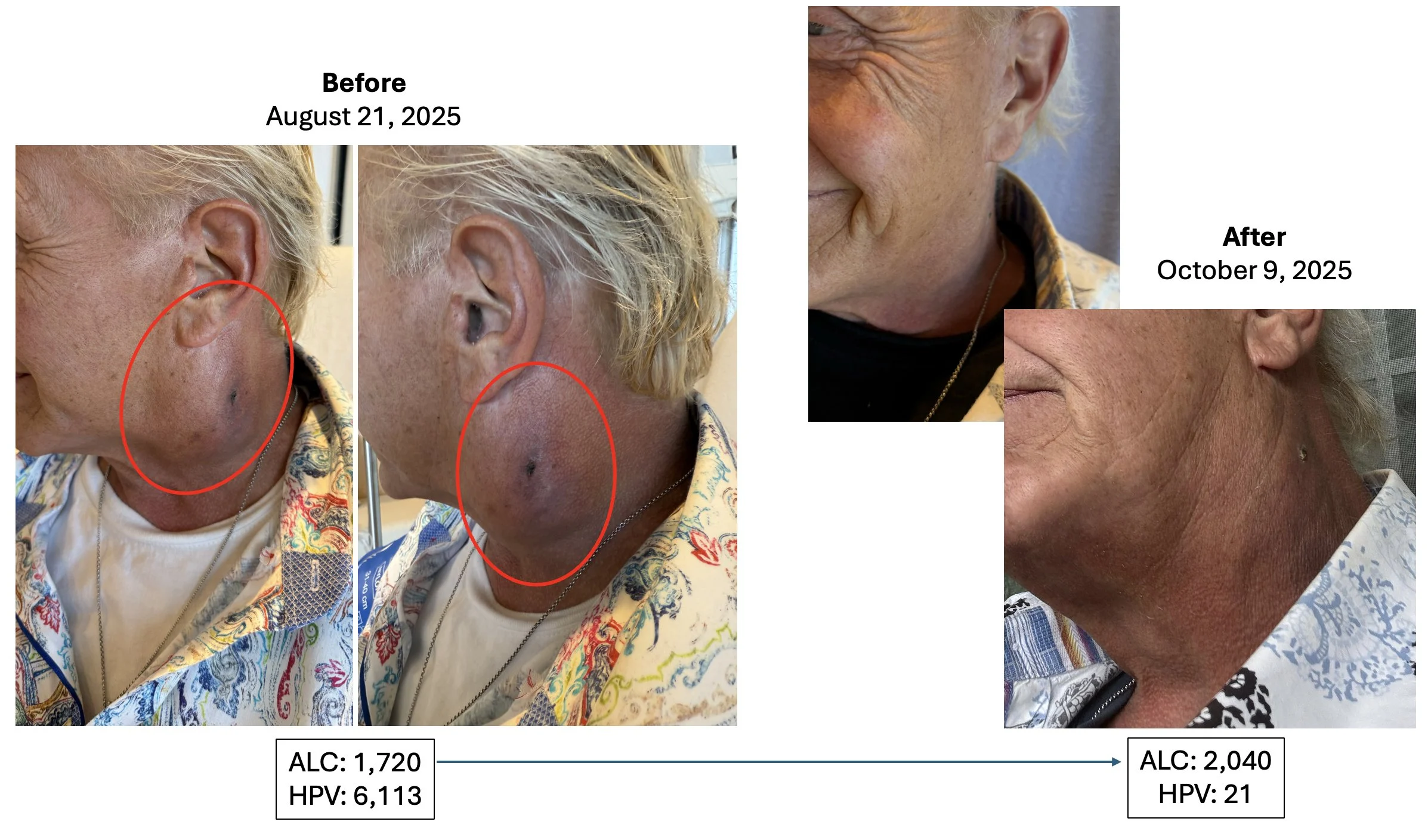 Patrick Soon-Shiong: The Overlooked Immune Failure Driving Cancer Mortality - A Clinical Blind Spot 7 Patrick Soon-Shiong: The Overlooked Immune Failure Driving Cancer Mortality - A Clinical Blind Spot