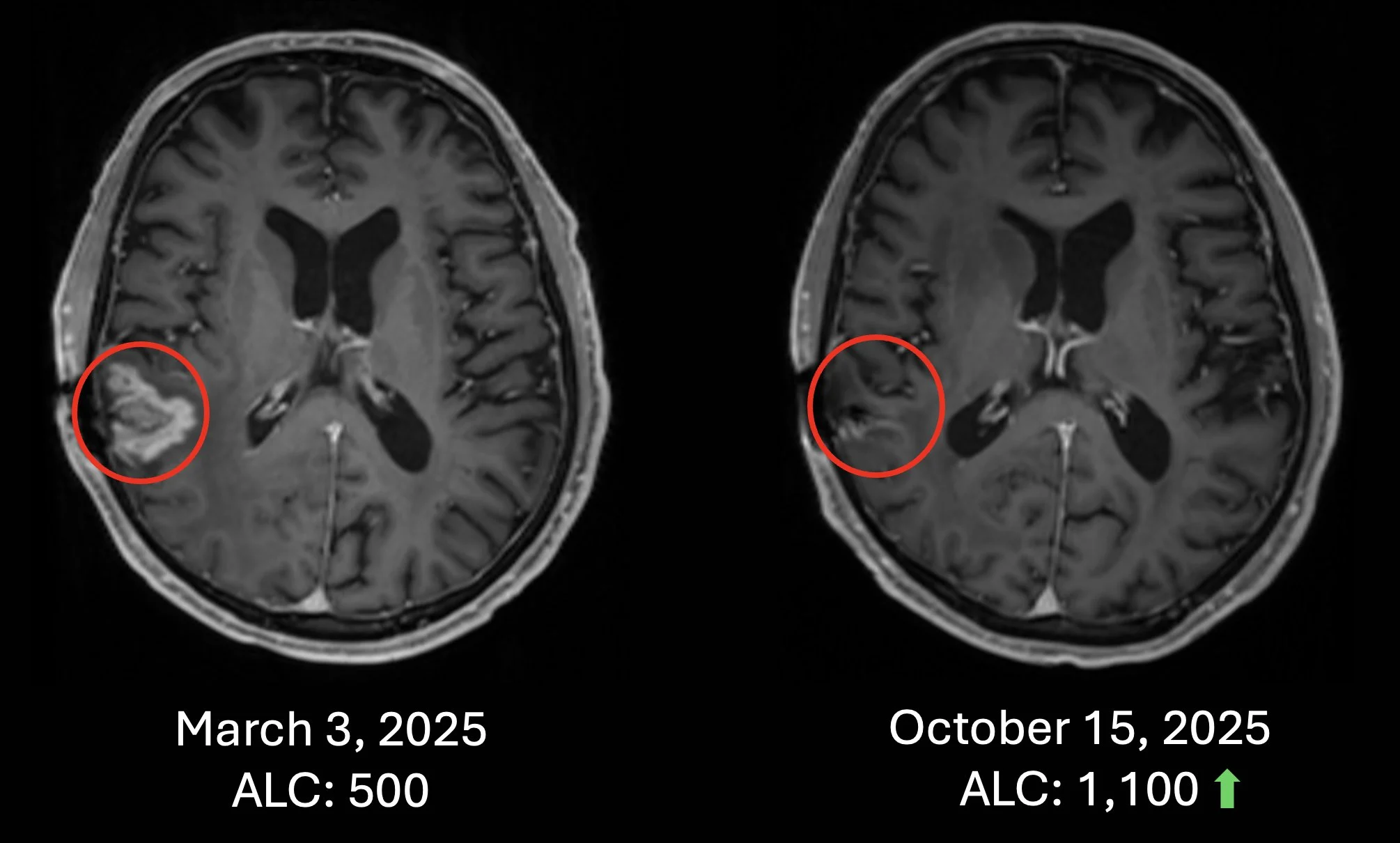 Patrick Soon-Shiong: The Overlooked Immune Failure Driving Cancer Mortality - A Clinical Blind Spot 8 Patrick Soon-Shiong: The Overlooked Immune Failure Driving Cancer Mortality - A Clinical Blind Spot