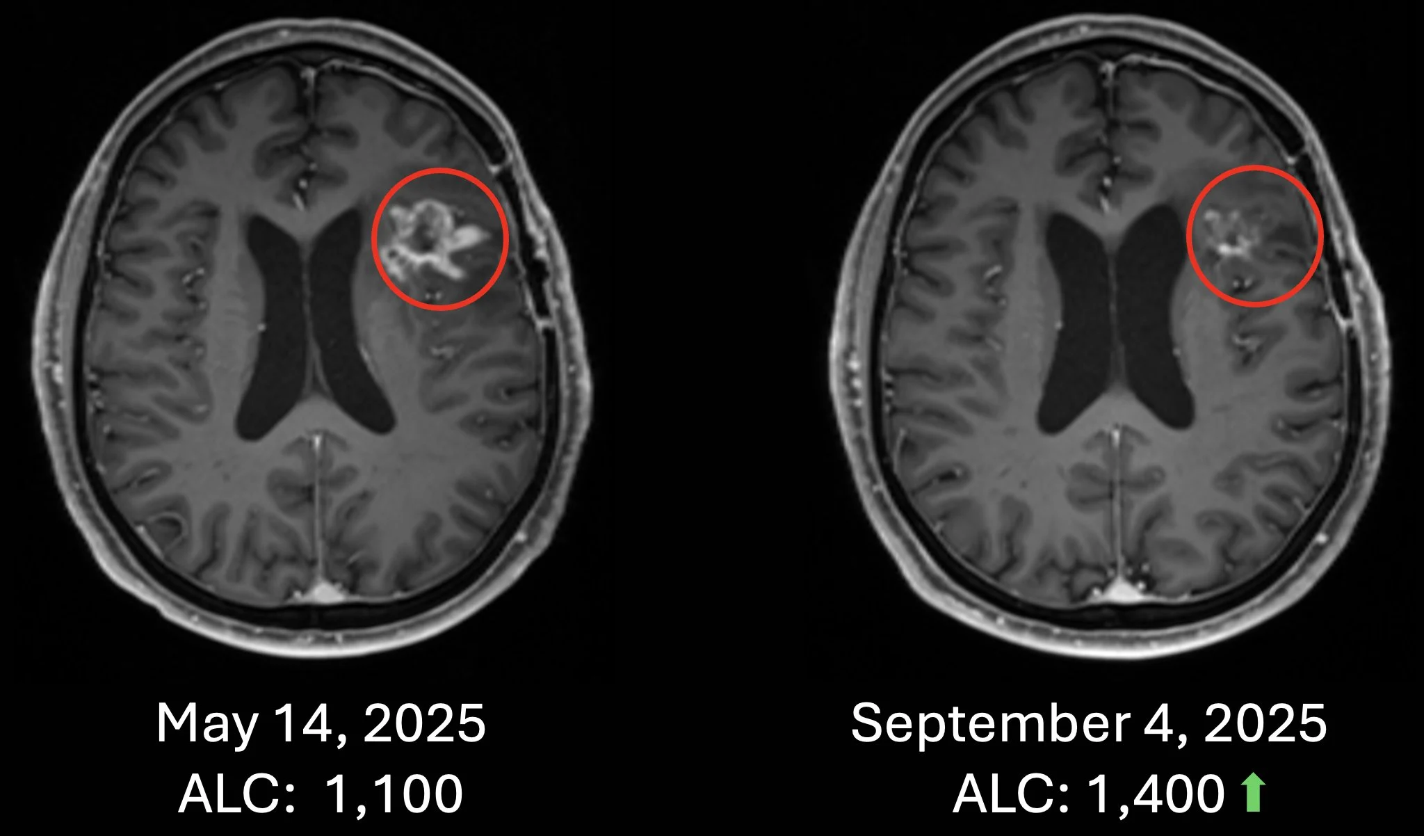 Patrick Soon-Shiong: The Overlooked Immune Failure Driving Cancer Mortality - A Clinical Blind Spot 9 Patrick Soon-Shiong: The Overlooked Immune Failure Driving Cancer Mortality - A Clinical Blind Spot