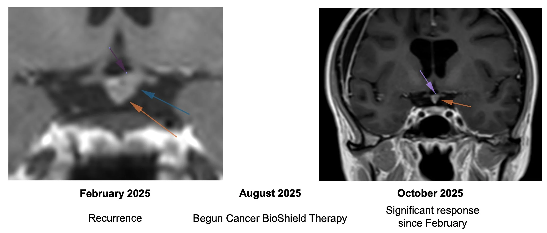 Patrick Soon-Shiong: The Overlooked Immune Failure Driving Cancer Mortality - A Clinical Blind Spot 10 Patrick Soon-Shiong: The Overlooked Immune Failure Driving Cancer Mortality - A Clinical Blind Spot