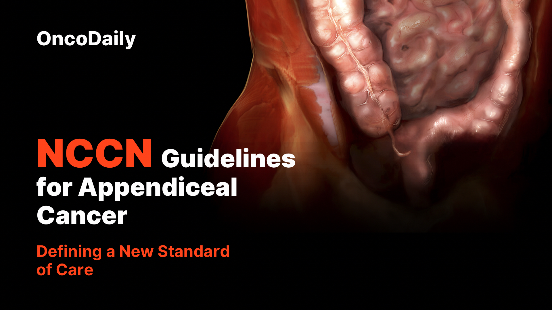 NCCN Guidelines for Appendiceal Cancer