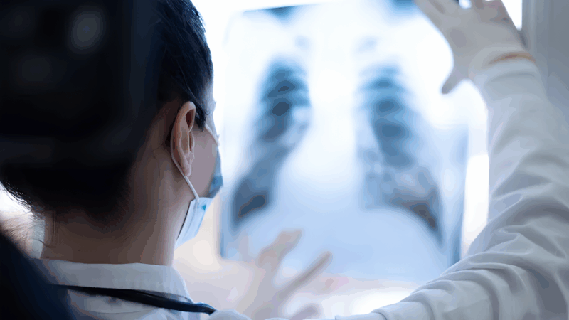 Jeff Yang: Why Lung Cancer Screening Is Still Severely Underused