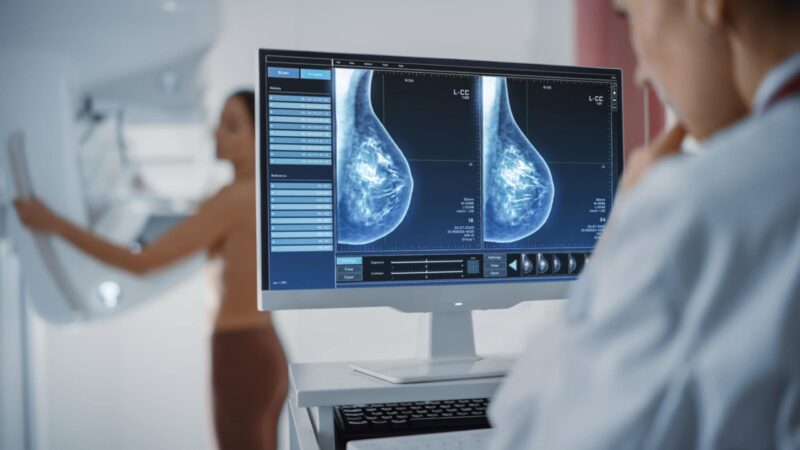 Sahar Mansour: AI Helps Detect Missed Contralateral Breast Cancer During Live Session