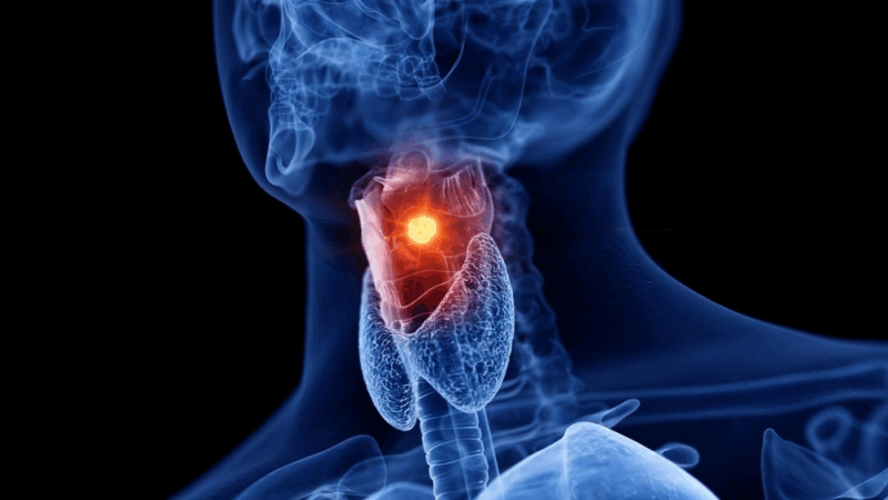 Faizan Bashir: Could Metabolic Syndrome Predispose Individuals to Laryngeal Cancer?