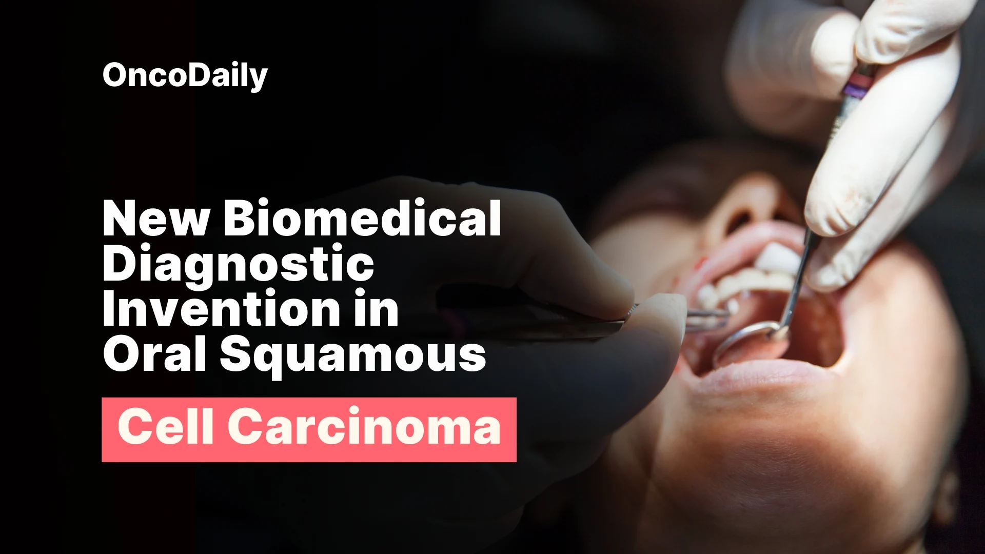 A New Invention: Nanoparticle-Based Salivary Biosensor for Early Detection of Oral Squamous Cell Carcinoma