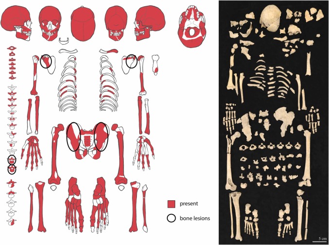 A Man From the Roman Empire Diagnosed With Metastatic Cancer 1,700 Years After His Death 5 gjb