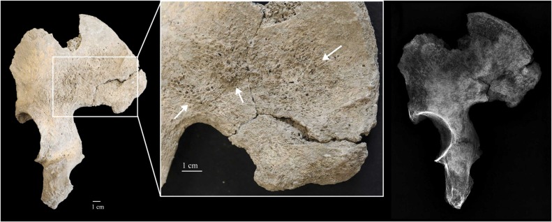 A Man From the Roman Empire Diagnosed With Metastatic Cancer 1,700 Years After His Death 4 A Man From the Roman Empire Diagnosed With Metastatic Cancer 1,700 Years After His Death