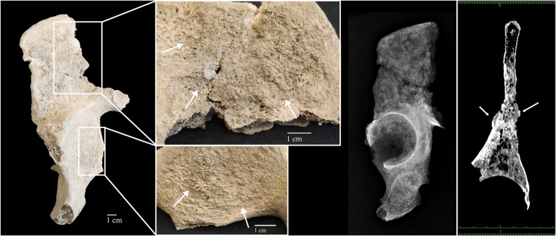 A Man From the Roman Empire Diagnosed With Metastatic Cancer 1,700 Years After His Death 3 hgjg