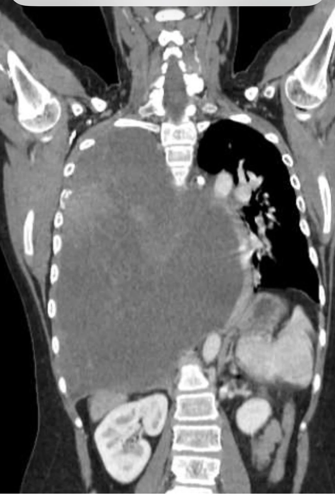 Kashyap Patel: Possible Link to Post-COVID Inflammation and 'Turbo Cancers'