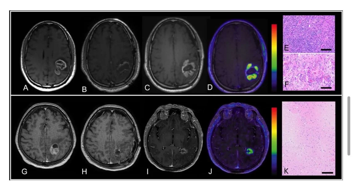 Jana Ivanidze: Multi-Institutional Study Validates Fluciclovine PET for Post-Treatment GBM Assessment