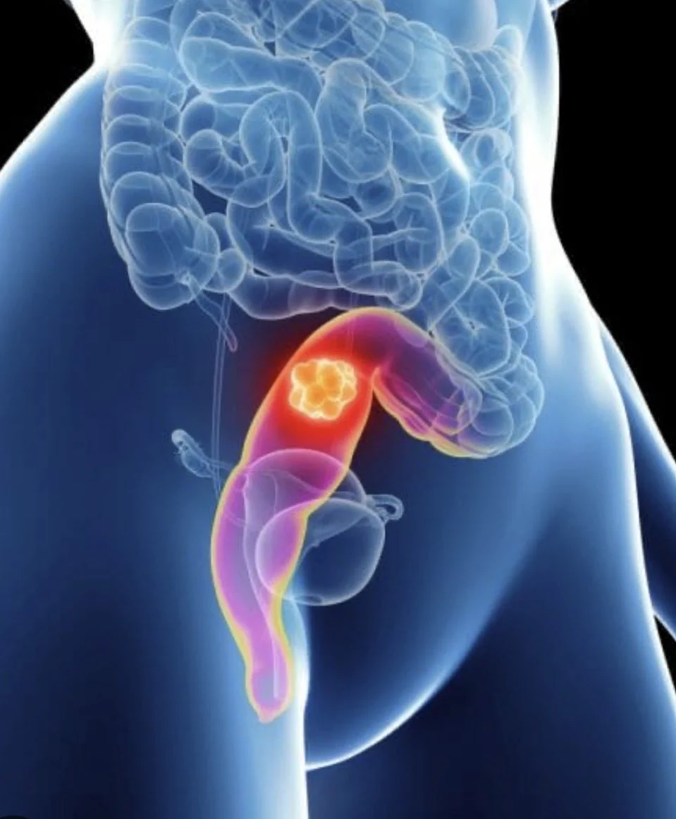 Stefan Moore: The Extraordinary Potential of Immunotherapy for a Specific Subtype of Rectal Cancer