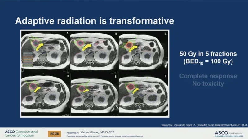 25 Posts Not To Miss From ASCO GI 2026, part 2 9 ASCO GI - OncoDaily