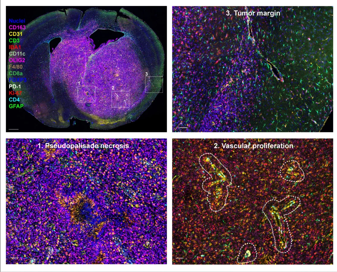 Dolores Hambardzumyan: High-Resolution Mapping of The Tumor Immune Landscape