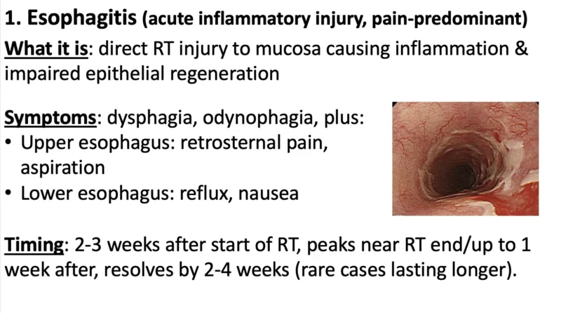 Nina Niu Sanford: Managing Toxicity in Upper GI Radiotherapy