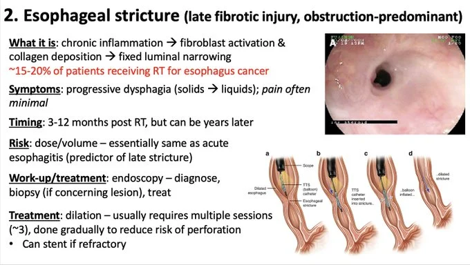 Nina Niu Sanford: Managing Toxicity in Upper GI Radiotherapy