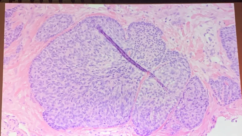 Ting Zhao: Fascinating GU Case Presented by Dr. Samson Fine 2 Ting Zhao: Fascinating GU Case Presented by Dr. Samson Fine