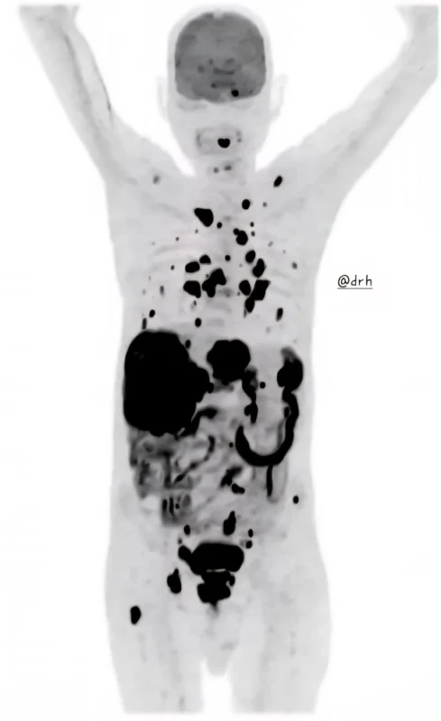 Harish Nagaraj: Tumor Sink Effect – When Biology Enhances Imaging 2 Harish Nagaraj