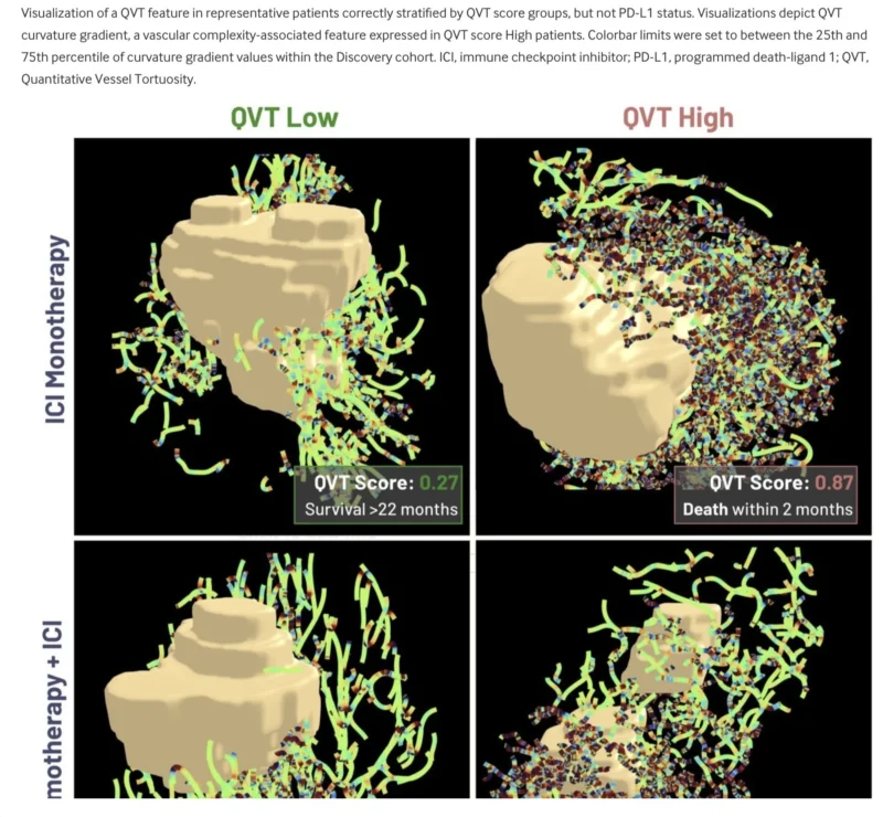 QVT Score In NSCLC Immunotherapy
