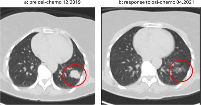 EGFR-Mutant NSCLC