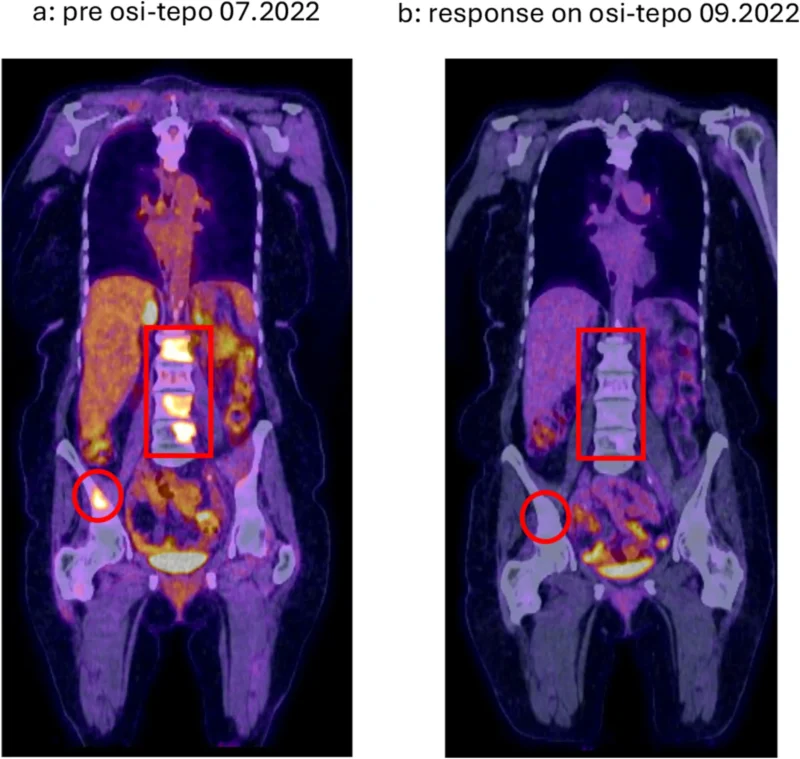 EGFR-Mutant NSCLC