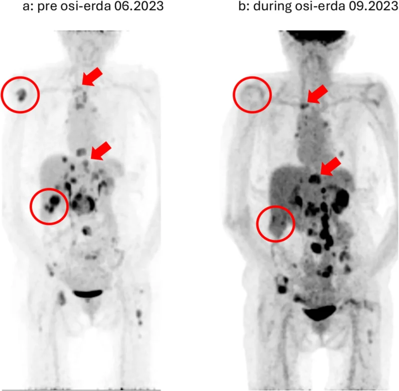 EGFR-Mutant NSCLC