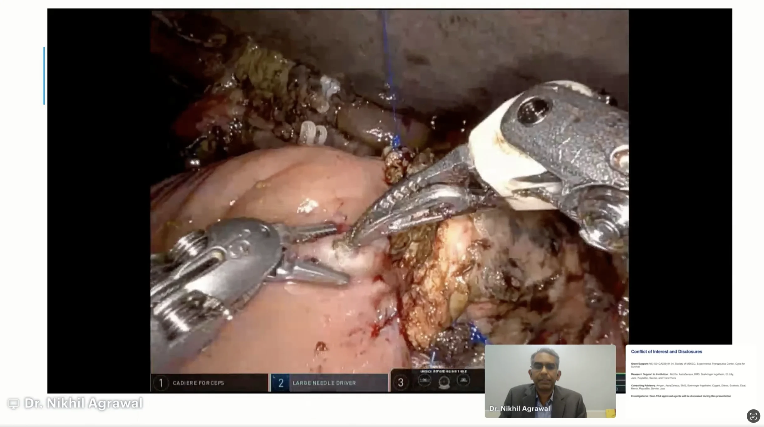 Key Insights from the OncoDaily Global Summit: How I Treat Gallbladder and Bile Duct Cancer in 2026