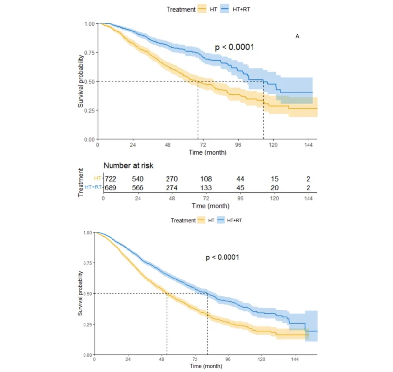 Prostate Radiotherapy - OncoDaily