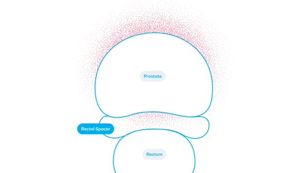 Spacing for Prostate Radiotherapy: Definitions, Mechanisms, Advancements, and Evolving Strategies