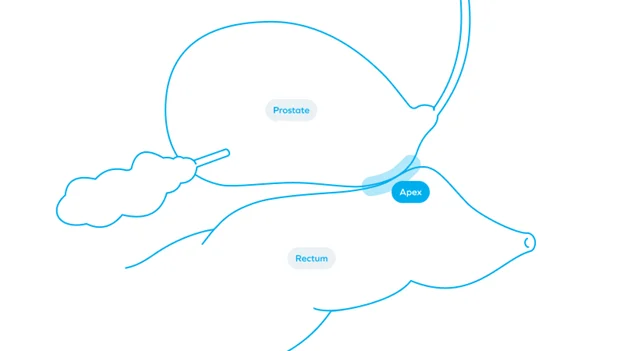 Spacing for Prostate Radiotherapy: Definitions, Mechanisms, Advancements, and Evolving Strategies