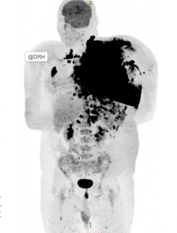 Harish Nagaraj: Beyond Detection - Molecular Imaging Guides Lymphoma Treatment Decisions