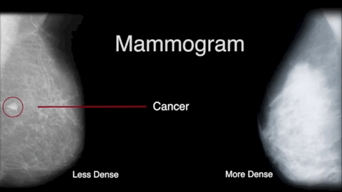 Siobhan Freeney: Breast Density Reporting in Women Undergoing Mammograms in Ireland 2 Siobhan Freeney: Breast Density Reporting in Women Undergoing Mammograms in Ireland