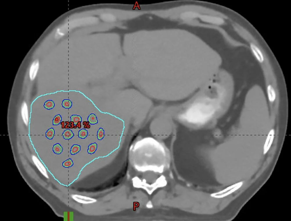 Ronald Chen: From Treating the Whole Tumor to a Dot Pattern Approach in Radiation Therapy