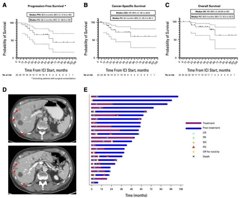 Mohammad Jad Moussa: Immune Checkpoint Inhibitors in dMMR/MSI-H Advanced Upper Tract Urothelial Carcinoma