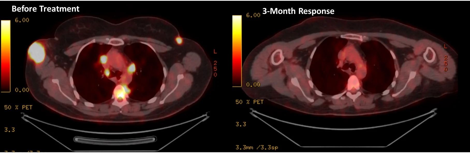 Ahmet Dirican: A Widely Metastatic Melanoma Patient with Unexpected Near Complete Response at 3 Months