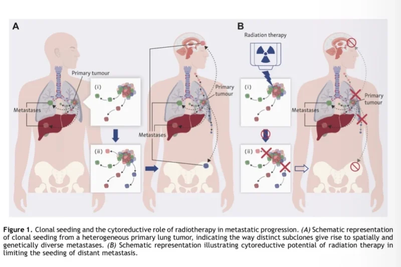 Definitive Radiotherapy to the Primary Tumor in Stage IV NSCLC: What the New IASLC Consensus Means 2 Definitive Radiotherapy