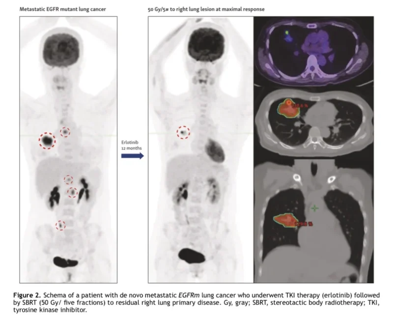 Definitive Radiotherapy to the Primary Tumor in Stage IV NSCLC: What the New IASLC Consensus Means 3 Definitive Radiotherapy