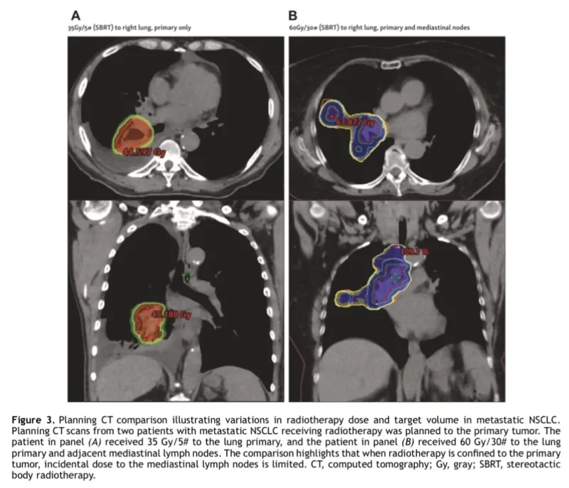 Definitive Radiotherapy to the Primary Tumor in Stage IV NSCLC: What the New IASLC Consensus Means 4 Definitive Radiotherapy