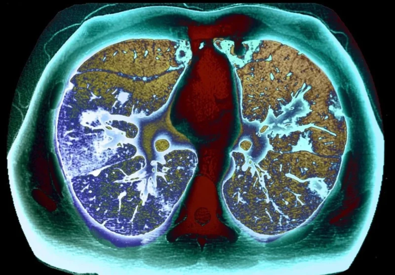 Lung Oncology