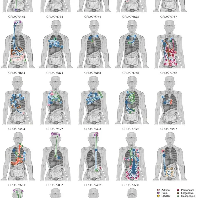 Adam Schoenfeld: TRACERx/PEACE Study On The Evolutionary Biology Of NSCLC Metastasis