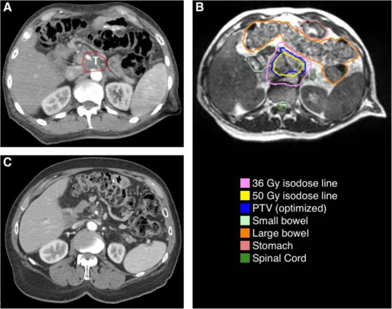 Nina Niu Sanford: SBRT for Locoregional Recurrence of Pancreatic Adenocarcinoma