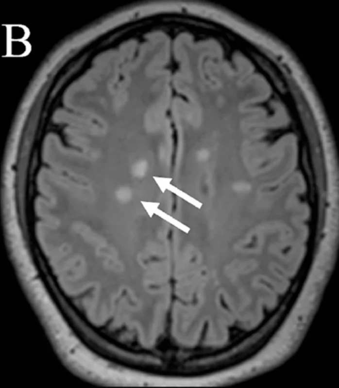 Paul Brown: Modern CNS RT and Multiple Sclerosis