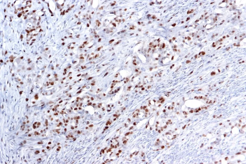 Veli Bakalov: MSI High Tumors Changed Cancer Immunotherapy 3 Veli Bakalov: MSI High Tumors Changed Cancer Immunotherapy