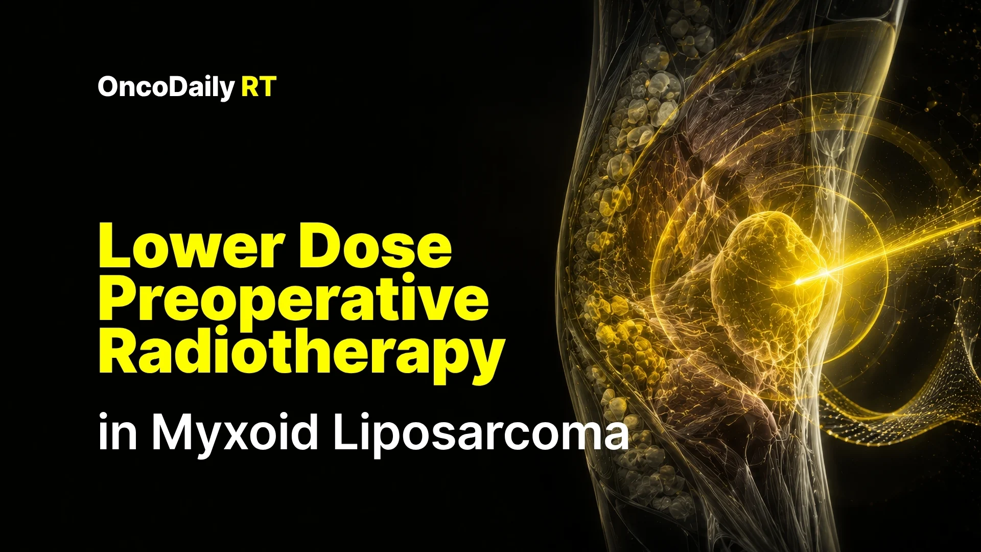 Lower Dose Preoperative Radiotherapy in Myxoid Liposarcoma